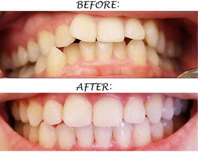 orthodontic before and after (1).jpg